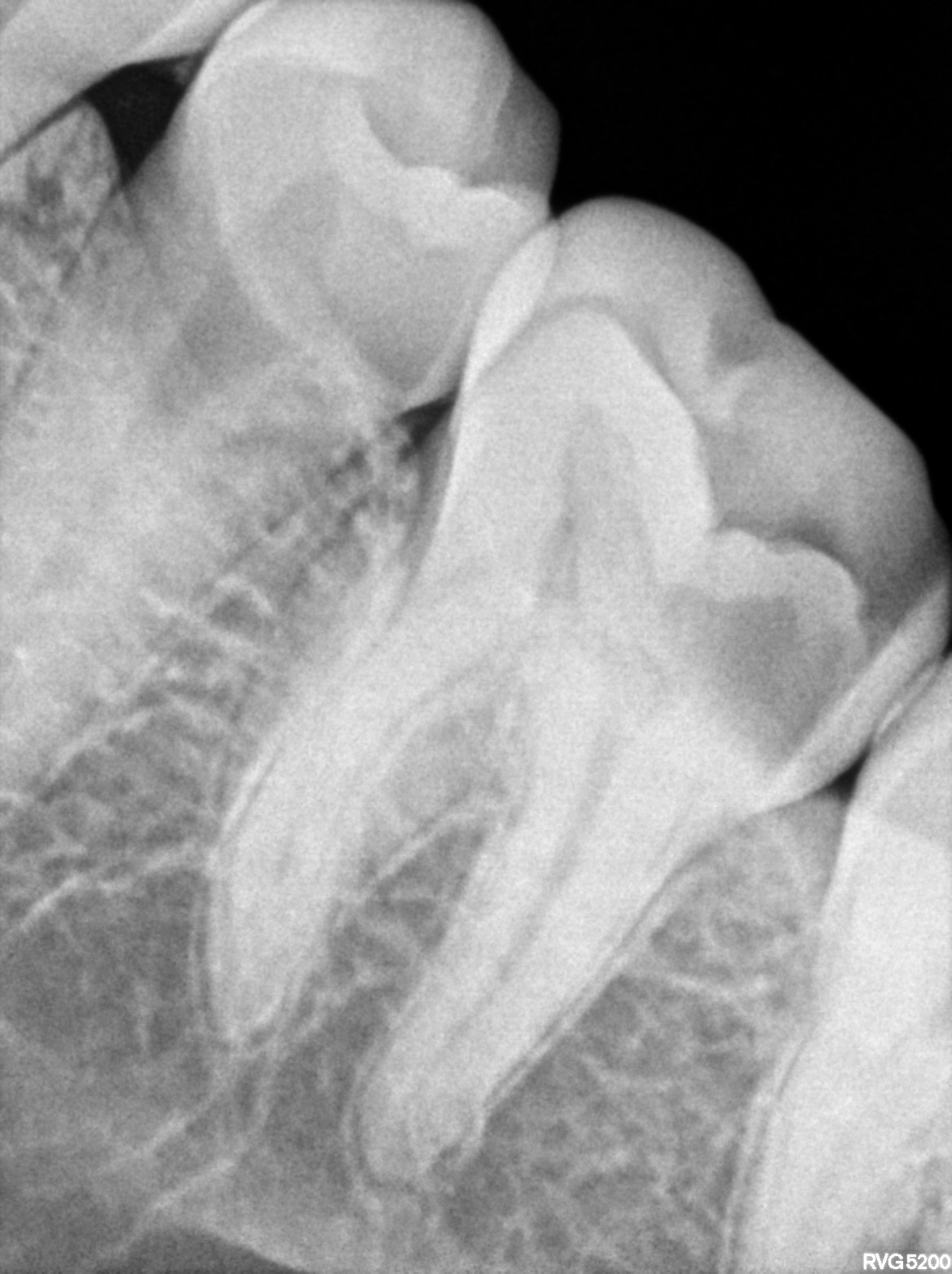 Dental X-ray